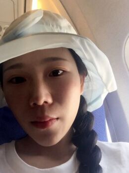 激光去雀斑后皮肤干净白皙多了，青岛华韩汪晓波做的