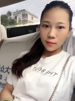 激光去雀斑后皮肤干净白皙多了，青岛华韩汪晓波做的