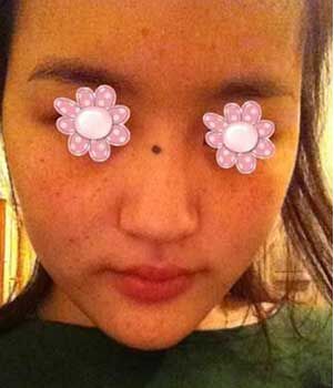 激光去雀斑把我遗传性的雀斑给全部去掉啦