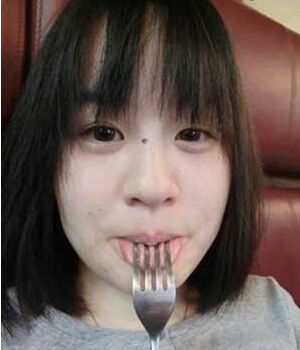 激光去雀斑把我遗传性的雀斑给全部去掉啦