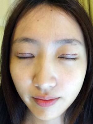 何贤清全切双眼皮加去脂肪 果贼自然