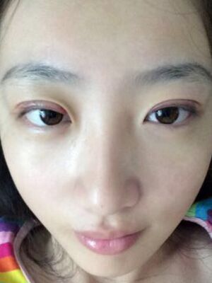 何贤清全切双眼皮加去脂肪 果贼自然