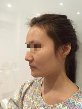 终于做了颧骨内推了还是在北京八大处果我放心