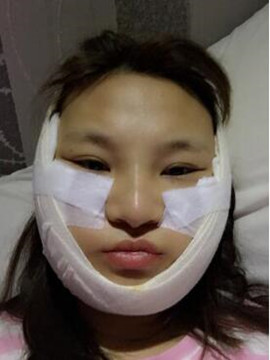 终于做了颧骨内推了还是在北京八大处果我放心