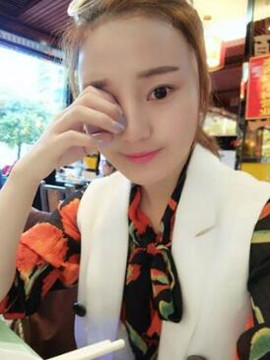 终于做了颧骨内推了还是在北京八大处果我放心