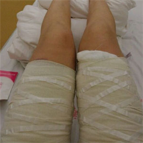 东方和谐冯斌做的大腿吸脂，给你们看看前后对比果图片！