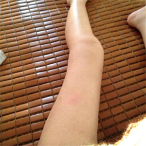 去东方和谐做了大腿抽脂，分享一下我的前后对比果图片吧！