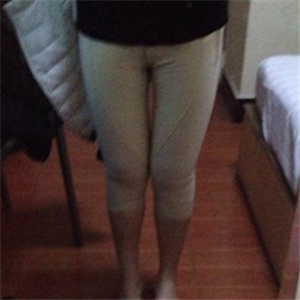 看看我大腿吸脂的前后对比果图片吧，是东方和谐张准做的