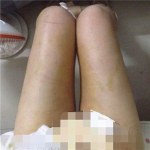 看看我大腿吸脂的前后对比果图片吧，是东方和谐张准做的