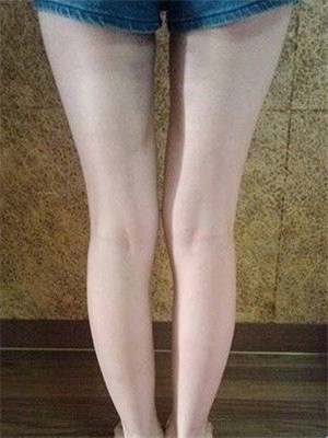 去年东方和谐张准医生做的大腿抽脂，分享一下我的前后对比果图片！