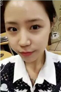 找夏正义做自体脂肪面部填充三个月了，恢复果很好有对比照片哦~~