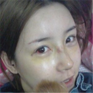 百*丽沈国雄做的隆鼻失败修复，恢复果很好，还有前后对比照片！