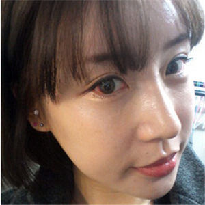 百*丽沈国雄做的隆鼻失败修复，恢复果很好，还有前后对比照片！