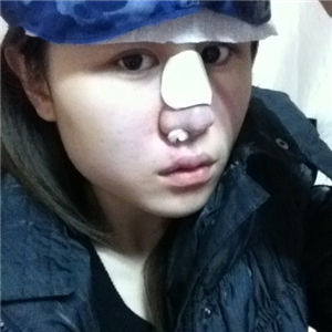 百*丽徐晓斐做的膨体假体隆鼻，给你们看看前后对比果图片~