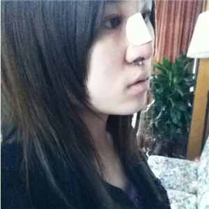 百*丽徐晓斐做的膨体假体隆鼻，给你们看看前后对比果图片~