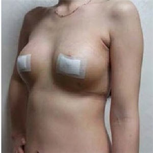 南昌同济做的极速动感微创丰胸术，分享下我的恢复过程图片吧~