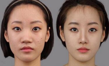 隆鼻+鼻翼缩小前后对比图