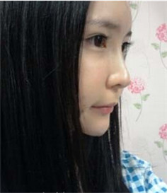 大家都来评价一下刘琦做的玻尿酸隆鼻果 还不错吧