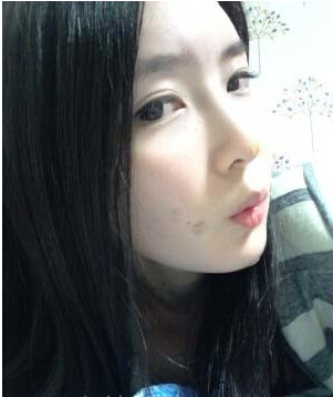 大家都来评价一下刘琦做的玻尿酸隆鼻果 还不错吧