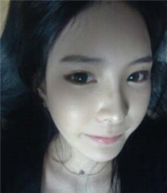 大家都来评价一下刘琦做的玻尿酸隆鼻果 还不错吧