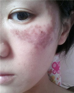 华美杜姜做的激光祛斑 果好不好你来看