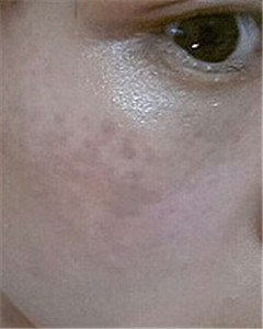 华美杜姜做的激光祛斑 果好不好你来看