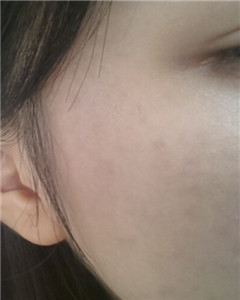 华美杜姜做的激光祛斑 果好不好你来看