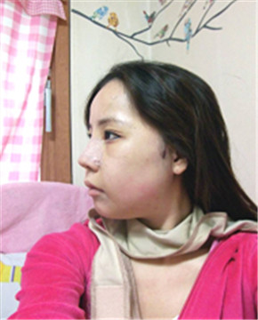 下颌角整形做完变小脸 孙丽君医生棒棒哒