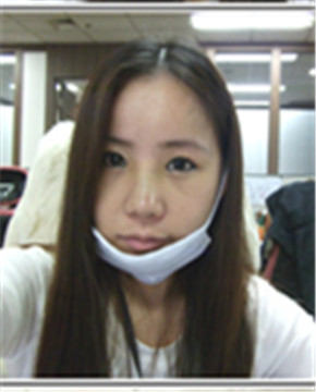 下颌角整形做完变小脸 孙丽君医生棒棒哒