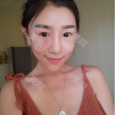 我自体脂肪面部填充后甩掉了干瘪脸重回18岁了