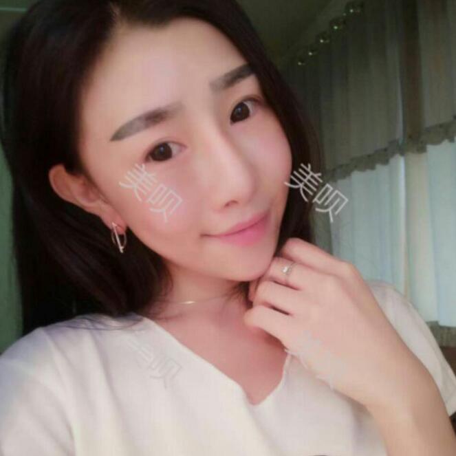 我自体脂肪面部填充后甩掉了干瘪脸重回18岁了