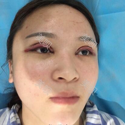 在成都艺美汇做的切开双眼皮+开眼角果还可以吧