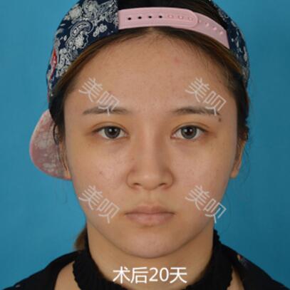 在成都艺美汇做的切开双眼皮+开眼角果还可以吧