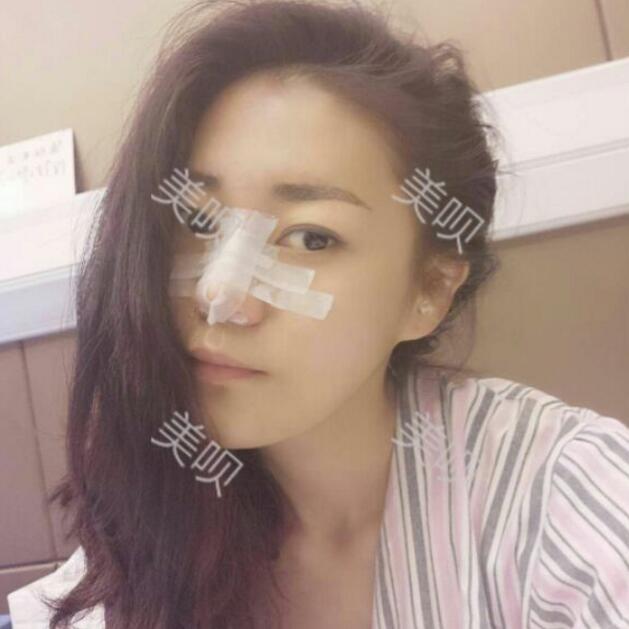 自体脂肪隆鼻+割双眼皮恢复后的果我很满意