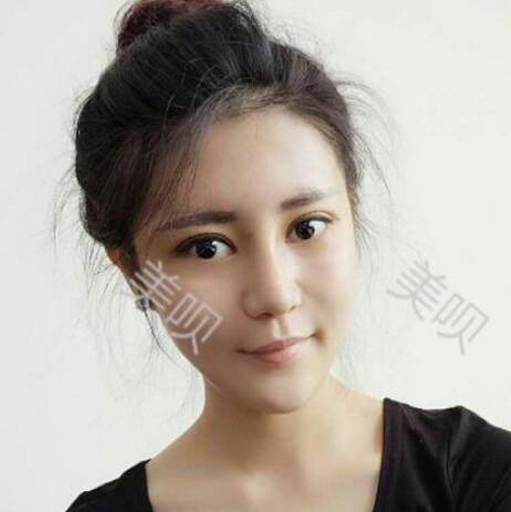 自体脂肪隆鼻+割双眼皮恢复后的果我很满意