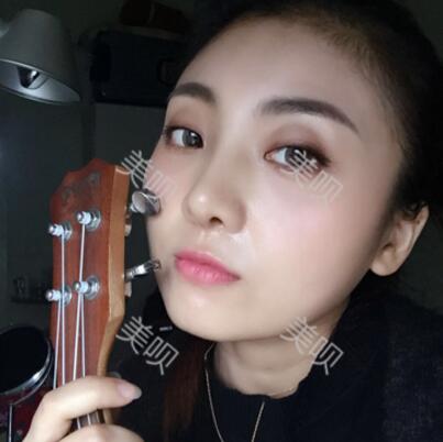 我的玻尿酸隆鼻后大家来看看果怎么样