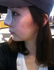 深圳希思崔院长隆鼻整形 摆脱了猪妹妹的称号