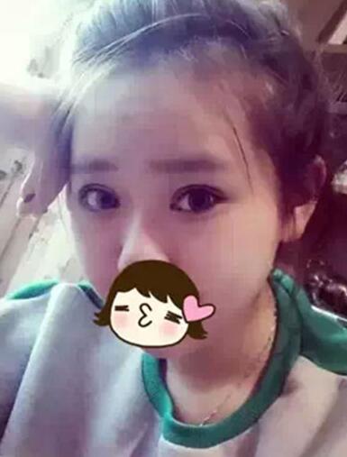 深圳希思做的双眼皮+开眼角 感谢杨医师！