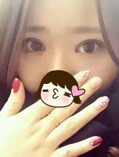 深圳希思做的双眼皮+开眼角 感谢杨医师！