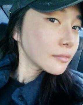 柳大烈给我做的改脸型手术 求围观！