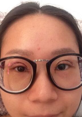 全切双眼皮改良了我的内双肿泡眼，多亏了何贤清医生