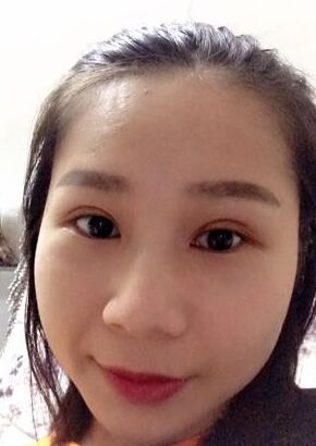 全切双眼皮改良了我的内双肿泡眼，多亏了何贤清医生