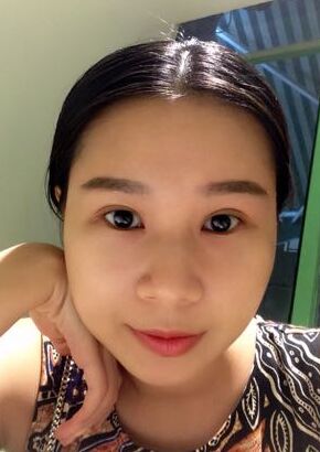 全切双眼皮改良了我的内双肿泡眼，多亏了何贤清医生