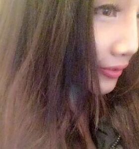 徐和林医生给我注射玻尿酸隆鼻后颜值up