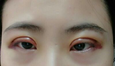 全切双眼皮后眼形漂亮多了，安徽维多利亚徐和林做的哟