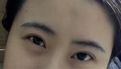 全切双眼皮后眼形漂亮多了，安徽维多利亚徐和林做的哟