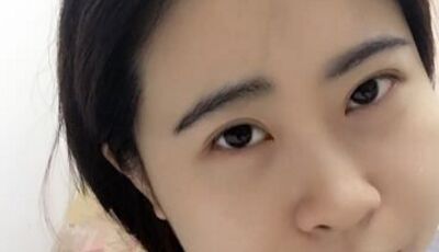 全切双眼皮后眼形漂亮多了，安徽维多利亚徐和林做的哟