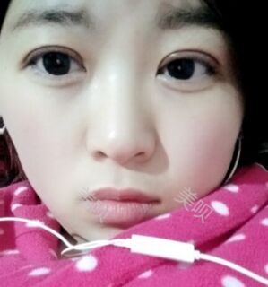 合肥壹加壹王大勇做的切开双眼皮分享给大家