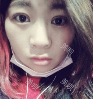 合肥壹加壹王大勇做的切开双眼皮分享给大家