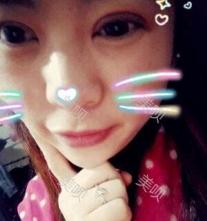 合肥壹加壹王大勇做的切开双眼皮分享给大家